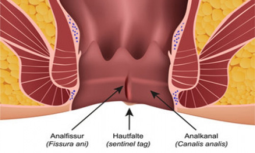 fissure symptoms