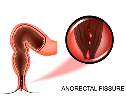 fissure types and treatment vithai piles clinic in pune