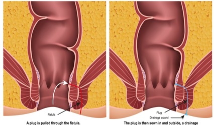 fistula types and treatment vithai piles clinic pune