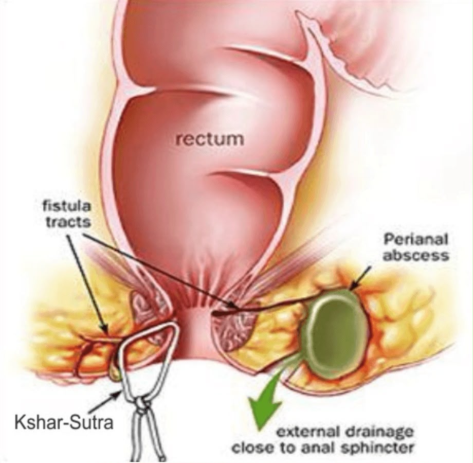 What Is Ksharasutra Treatment vithai piles clinic pune
