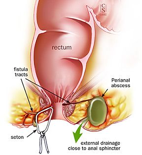 What Is a Perianal Abscess vithai piles clinic pune