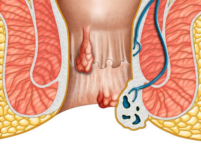 What Is a Pilonidal Sinus vithai piles clinic pune