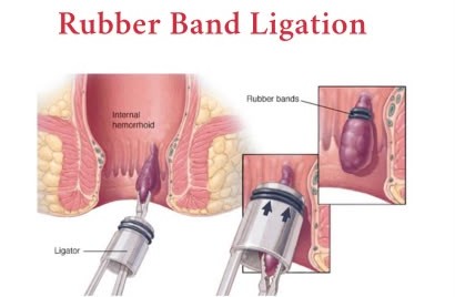 Advantages of Rubber Band Ligation - Vithai Piles Hospital Pune