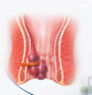 Recovery after Rubber Band Ligation - Vithai Piles Hospital Pune