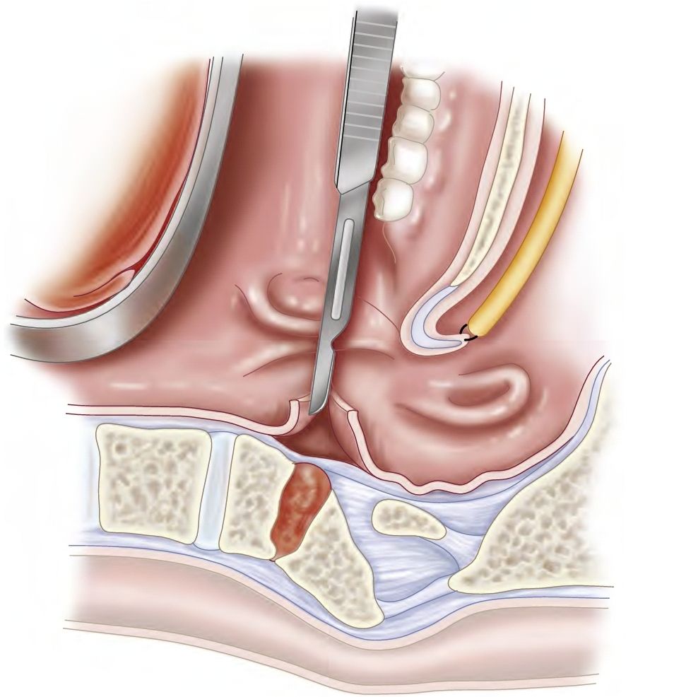 Stapler Surgery Advantages and Procedure - Vithai Piles Clinic Pune