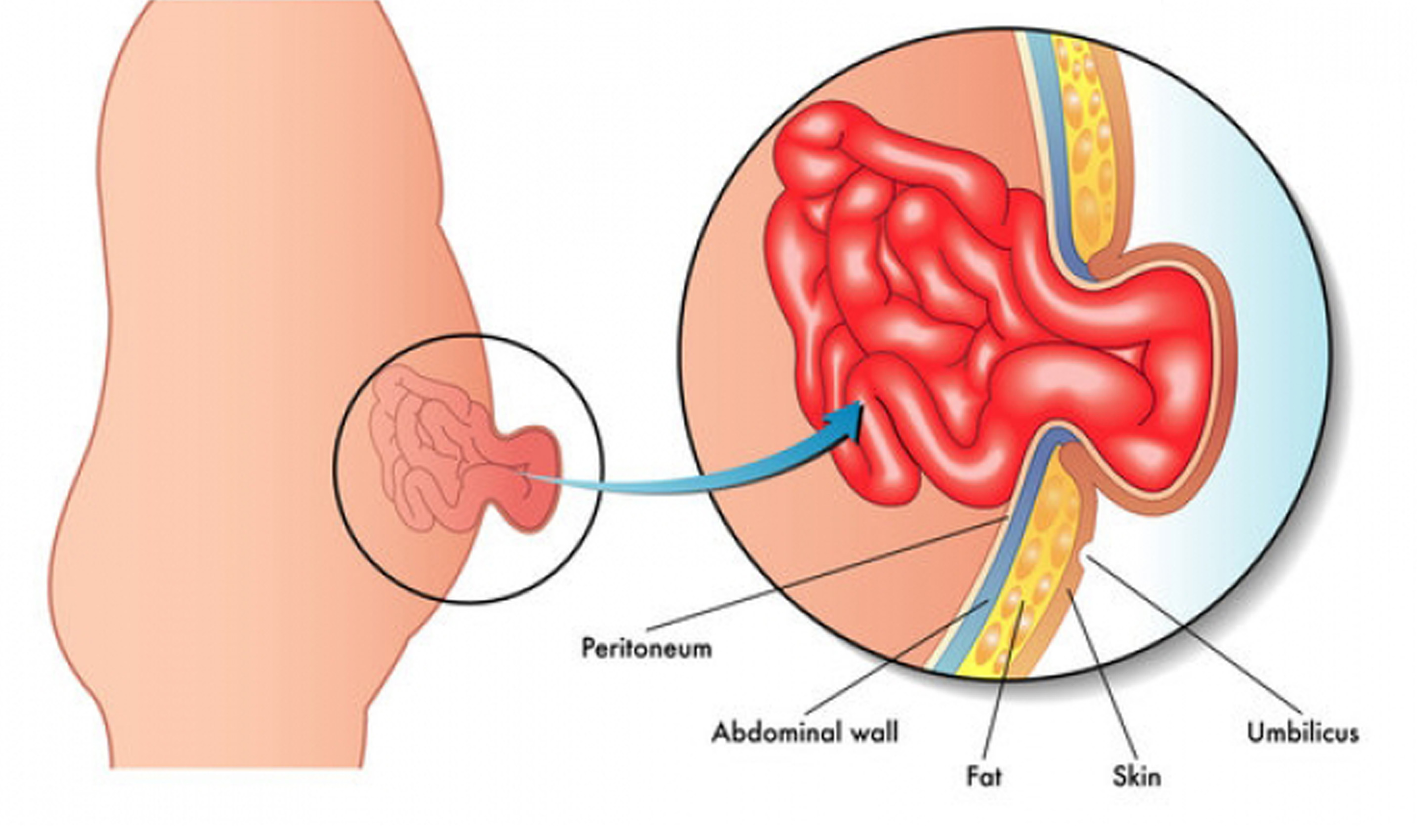 laser treatment for hernia vithai piles clinic pune